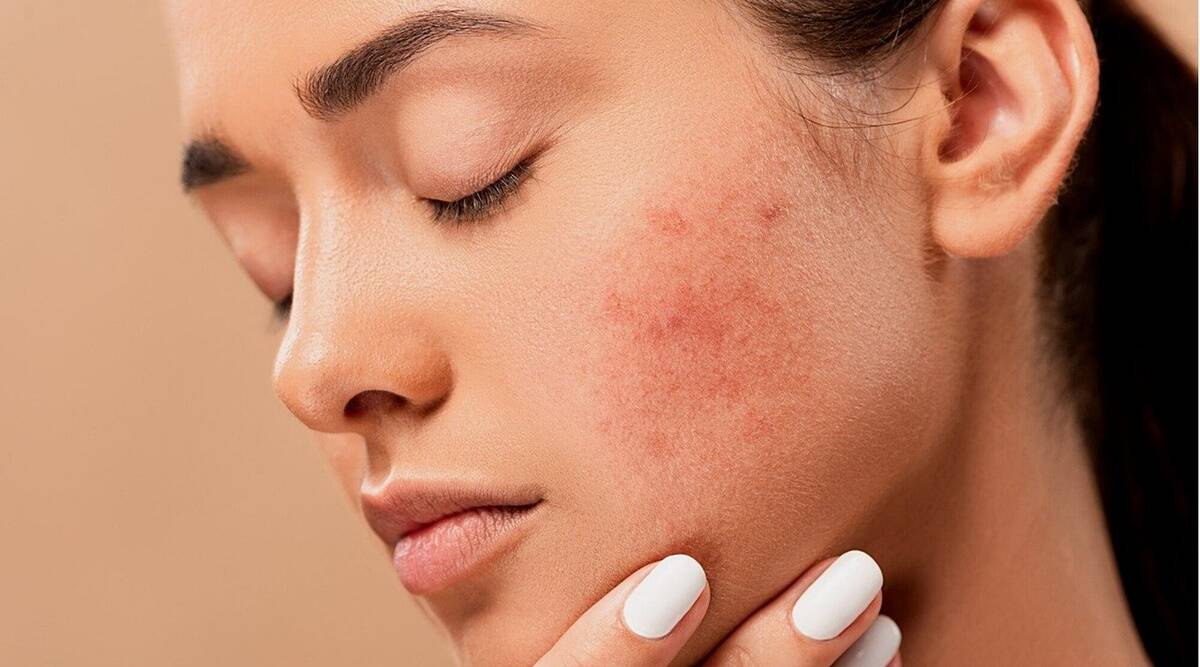 Acne Rosacea 101: How Should You Deal with It?