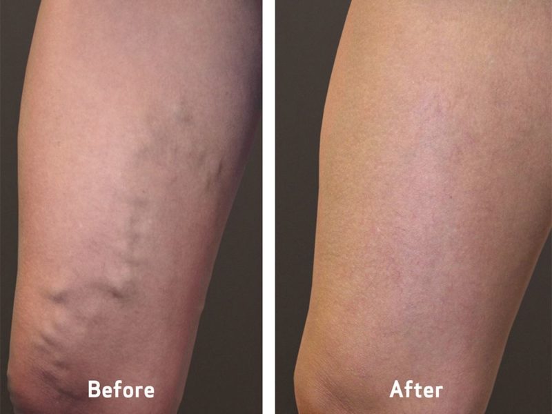 What can you Expect After a Laser Vein Treatment Session